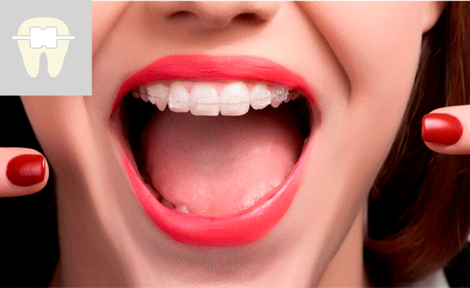 Brackets Ceramicos o esteticos